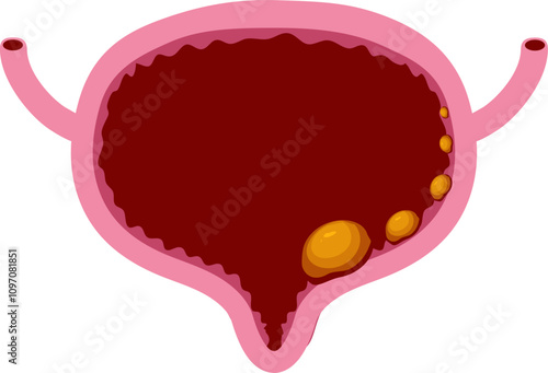 Bladder disease illustration. Urinary tract infection. Bladder cancer. Bladder stones. Bladder inconvenience.