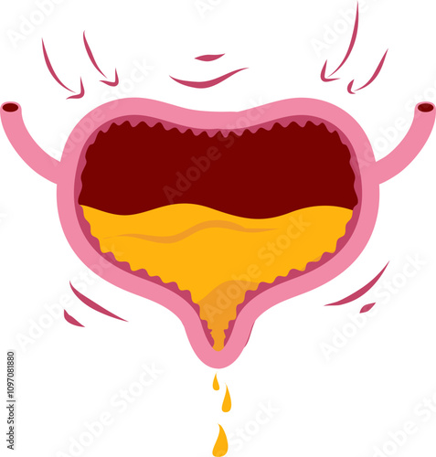 Bladder disease illustration. Urinary tract infection. Bladder cancer. Bladder stones. Bladder inconvenience.