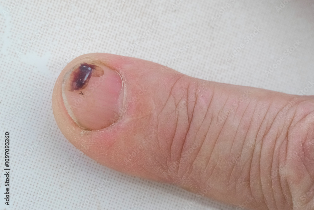 A man's finger with a hematoma on the nail after a blow A man's finger with a hematoma on the nail after a blow