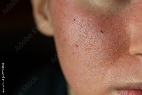 Obraz na płótnie Close-up of skin after laser resurfacing – CO2 fractionated laser. w salonie