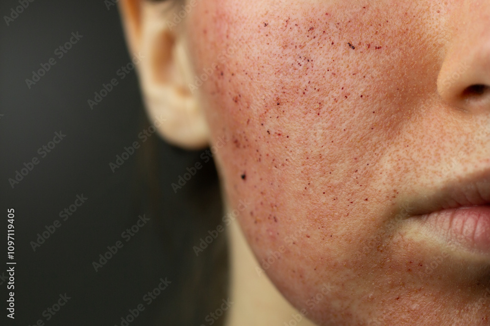 Close-up of skin after laser resurfacing – CO2 fractionated laser.