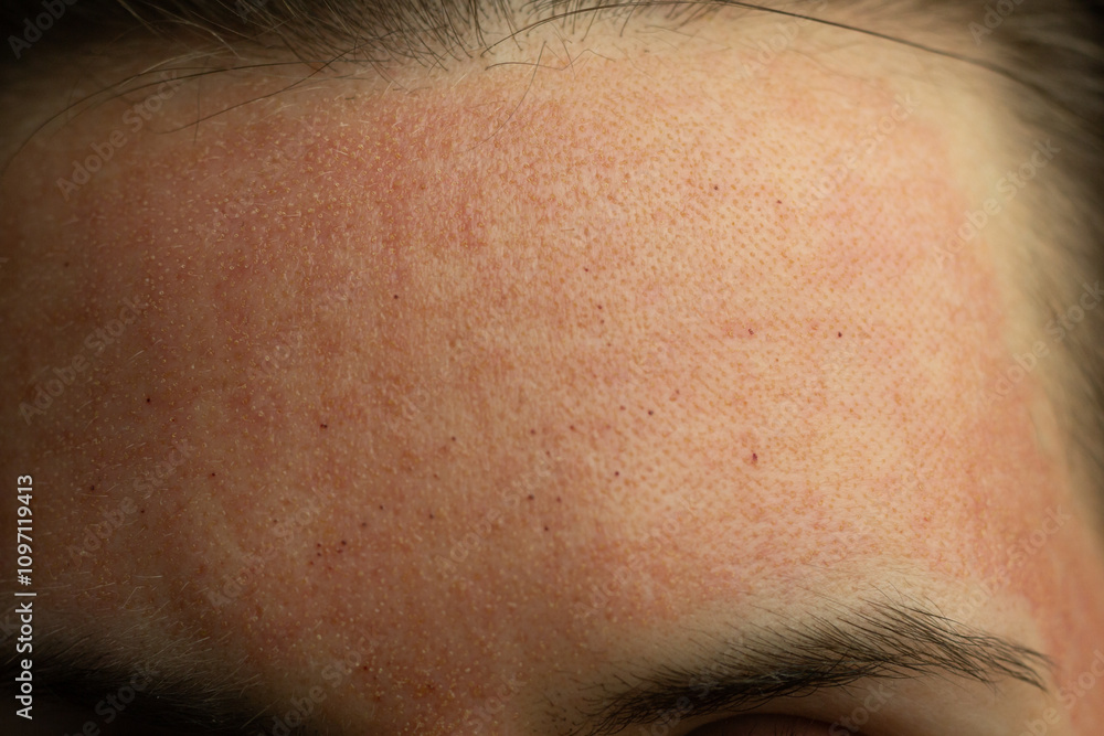 Close-up of skin after laser resurfacing – CO2 fractionated laser.