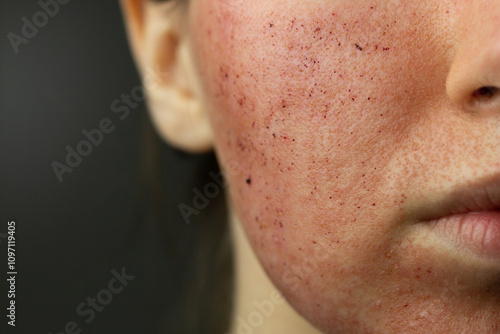 Obraz na płótnie Close-up of skin after laser resurfacing – CO2 fractionated laser. w salonie