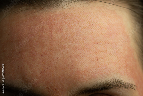 Obraz na płótnie Close-up of skin after laser resurfacing – CO2 fractionated laser. w salonie