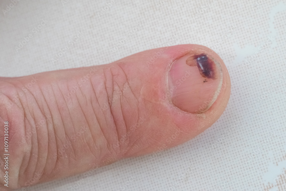 A man's finger with a hematoma on the nail after a blow A man's finger with a hematoma on the nail after a blow