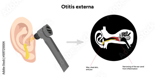 Otitis externa anatomy ear disease inflammation and check up in doctor appointment 