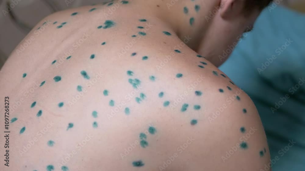 Detailed view of a chickenpox rash on a child's back, showcasing the ...
