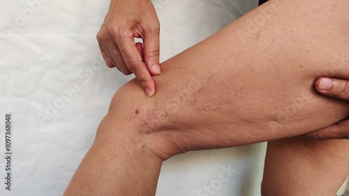 close up of a woman holding the flabbiness and wrinkle, problem circulation of blood, varicose veins and spider on the leg, health care and beauty concept. photo