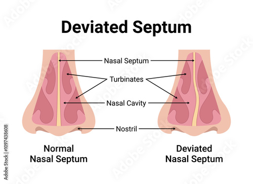 Deviated Nasal Septum Medical Vector Illustration