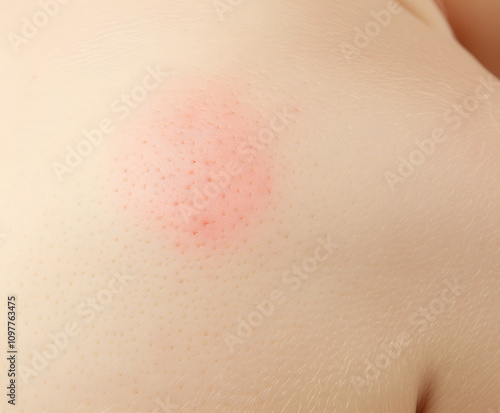 Localized Dermatitis on Skin photo