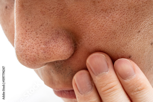 いちご鼻のクローズアップ：30代男性の毛穴と角栓