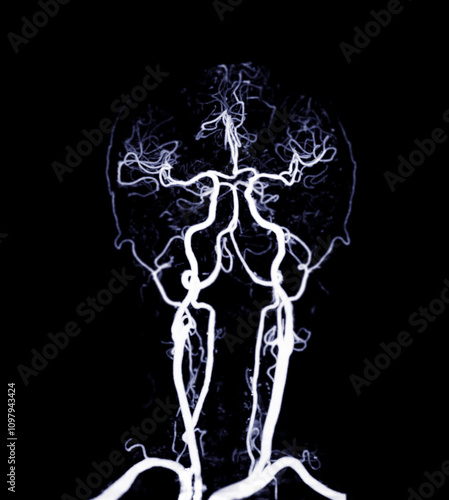 The CT Angiography (CTA) scan of the brain and neck, showcasing the intricate vascular network in vivid detail. It highlights major blood vessels, aiding in diagnosing cerebrovascular conditions.