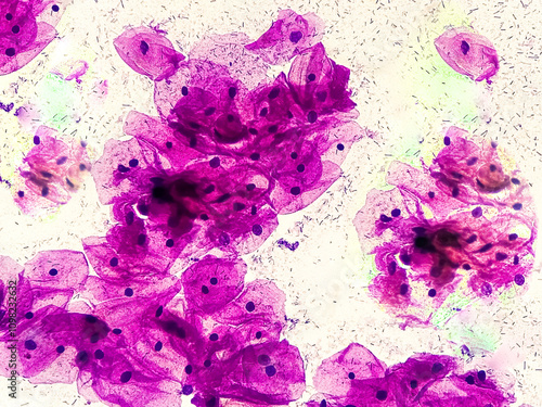 Blood cancer. Photomicrograph of Acute Myeloblastic Leukemia or AML, a cancer of white blood cell. Peripheral blood smear showing cancer cells. photo