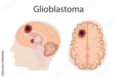 Section of the brain with glioblastoma tumor, Brain cancer concept.
