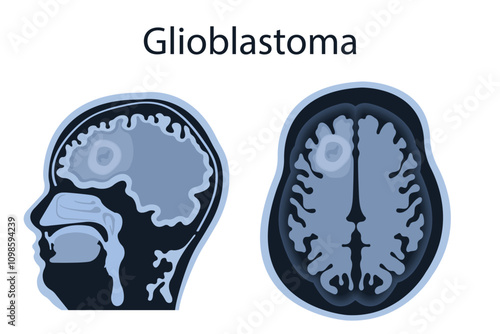 MRI of the brain shows frontal glioblastoma. Brain cancer concept