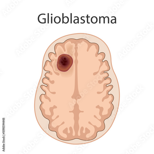 MRI of the brain shows frontal glioblastoma. Brain cancer concept