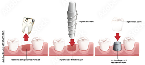 Dental Implant Procedure Illustration