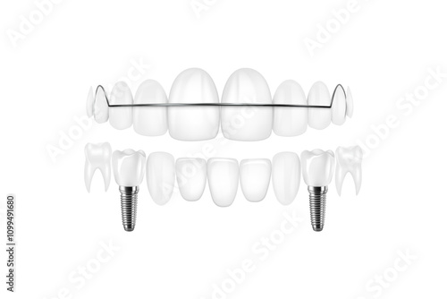 Dental implant structure medical pictorial educative infographic poster with molar replacement end healthy tools models vector illustration.