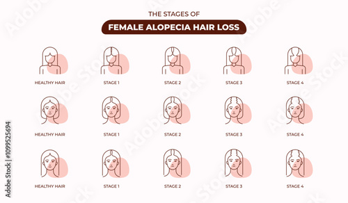 The Stages of Female Hair Loss Line Icon Set,  Hair Follicle, Transplantation, Healthy Hair, Stage, Clinic, Alopecia, Editable Stroke.