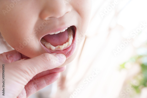 歯並びが悪い子供の口元