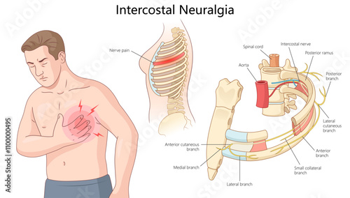 intercostal neuralgia, nerve pain in the chest with labeled intercostal nerve branches and anatomy diagram hand drawn schematic vector illustration. Medical science educational illustration