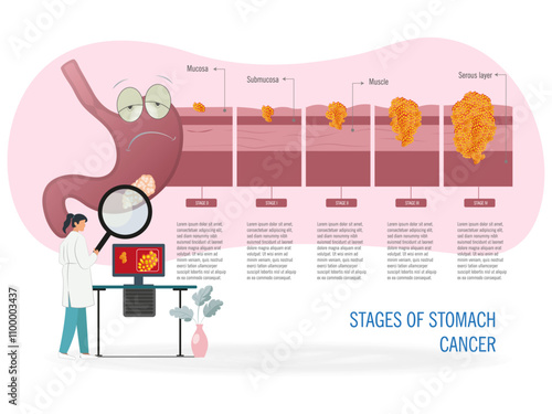 Stages of stomach cancer explained visually.nfographic showing the stages of stomach cancer, from the mucosa to the serous layer with illustrated details.