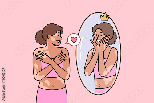 Woman with vitiligo syndrome or spots on skin looks in mirror and smiles, accepting herself as she is. Ethnic girl with high self-esteem and vitiligo disease feels sympathy for own reflection