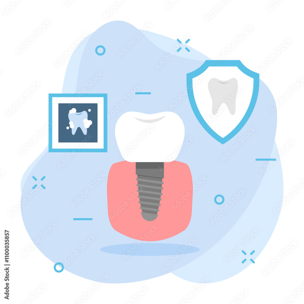 Dental Implant or Artificial prosthetic tooth root concept, Replace ...