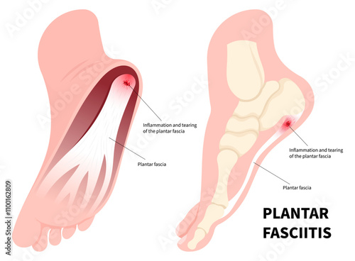 Heel pain and swelling in medical called Plantar Fasciitis of flat feet syndrome