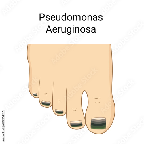 Green Nail Syndrome, toenail chloronychia