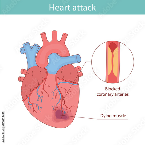 Myocardial infarction. Illustration of a human heart. Heart attack. Illustration in cartoon style