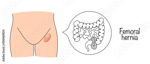 Femoral hernia