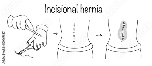Incisional Hernia