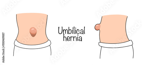 Umbilical hernia