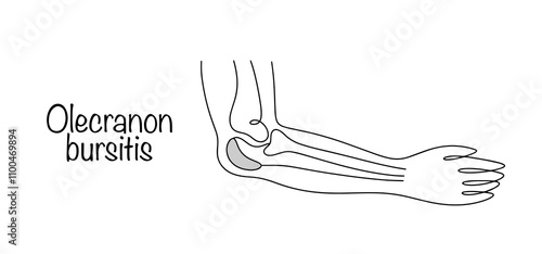Olecranon bursitis
