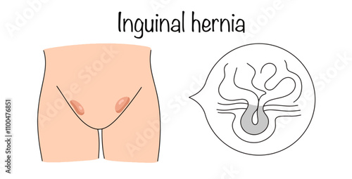 Inguinal hernia