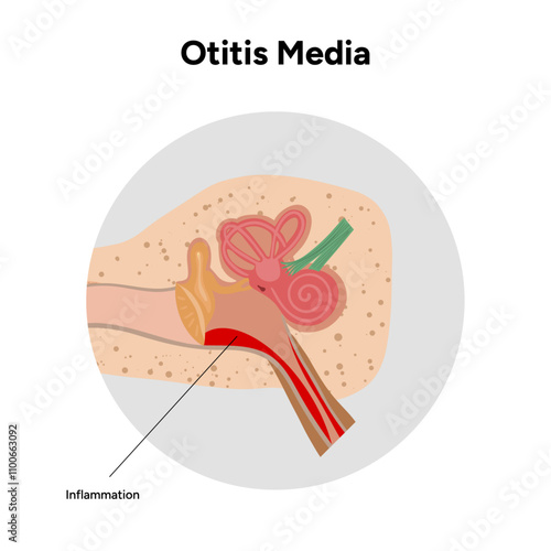 Otitis media inflammation anatomy human ear pain disease 
