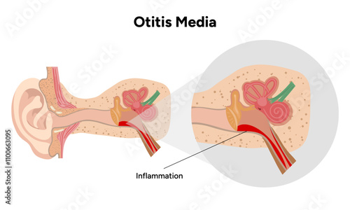 Otitis media inflammation anatomy human ear pain disease 