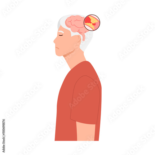 Man suffering from stroke. Ischemic stroke patient. brain with blood clot. blocked artery. Cerebral ischemia. Flat vector illustration