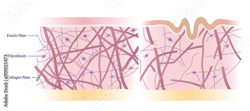 Cross section of skin layer with intact and damaged collagen, elastin fibers and fibroblasts in the dermis vector illustration on white background. Comparison of young healthy and aging wrinkled skin.