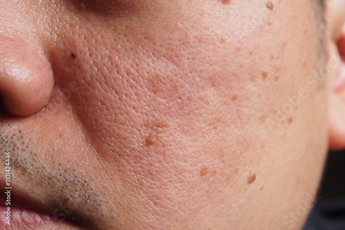 Closeup of red skin with acne, pores and moles on the face of a young Asian man Human health and aesthetics concept