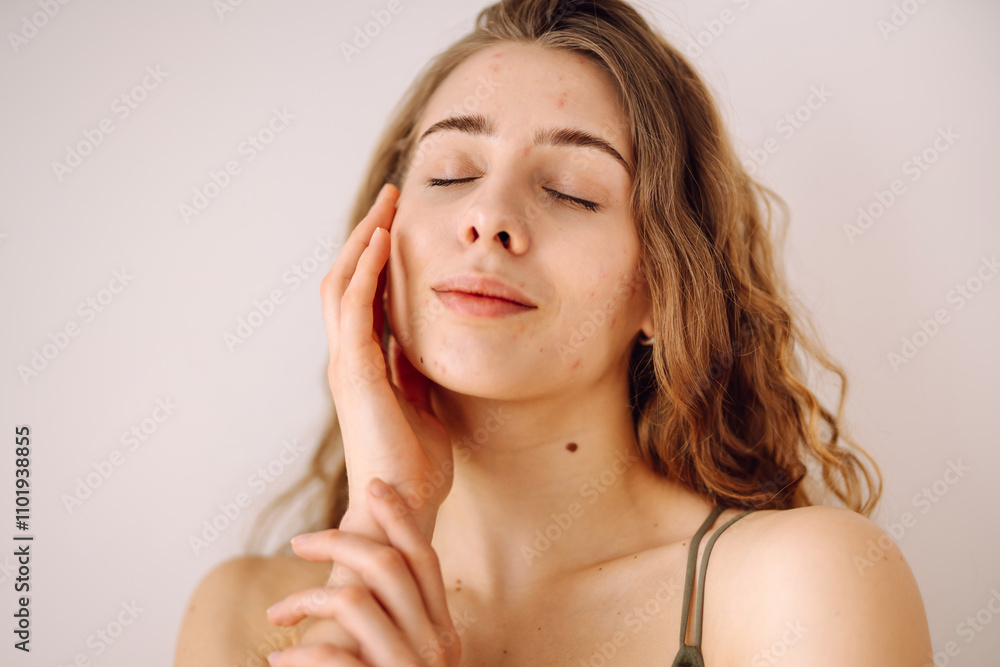 Portrait of a young girl with problem skin. Pimples, acne, pores, scars. Natural skin. Problem skin skincare. Portrait of a young girl with problem skin. Pimples, acne, pores, scars. Natural skin. Problem skin skincare.