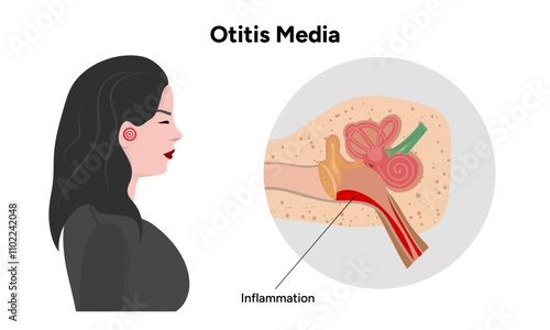 Otitis media inflammation anatomy human ear pain disease medical infographic 