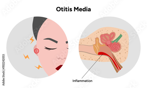 Otitis media inflammation anatomy human ear pain disease medical infographic 