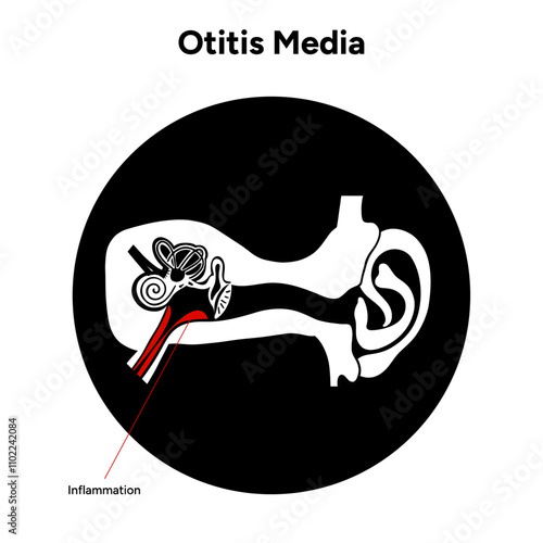Otitis media inflammation anatomy human ear pain disease medical infographic 