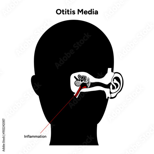 Otitis media inflammation anatomy human ear pain disease medical infographic 