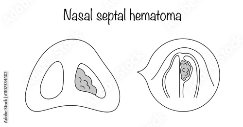 Nasal septal hematoma