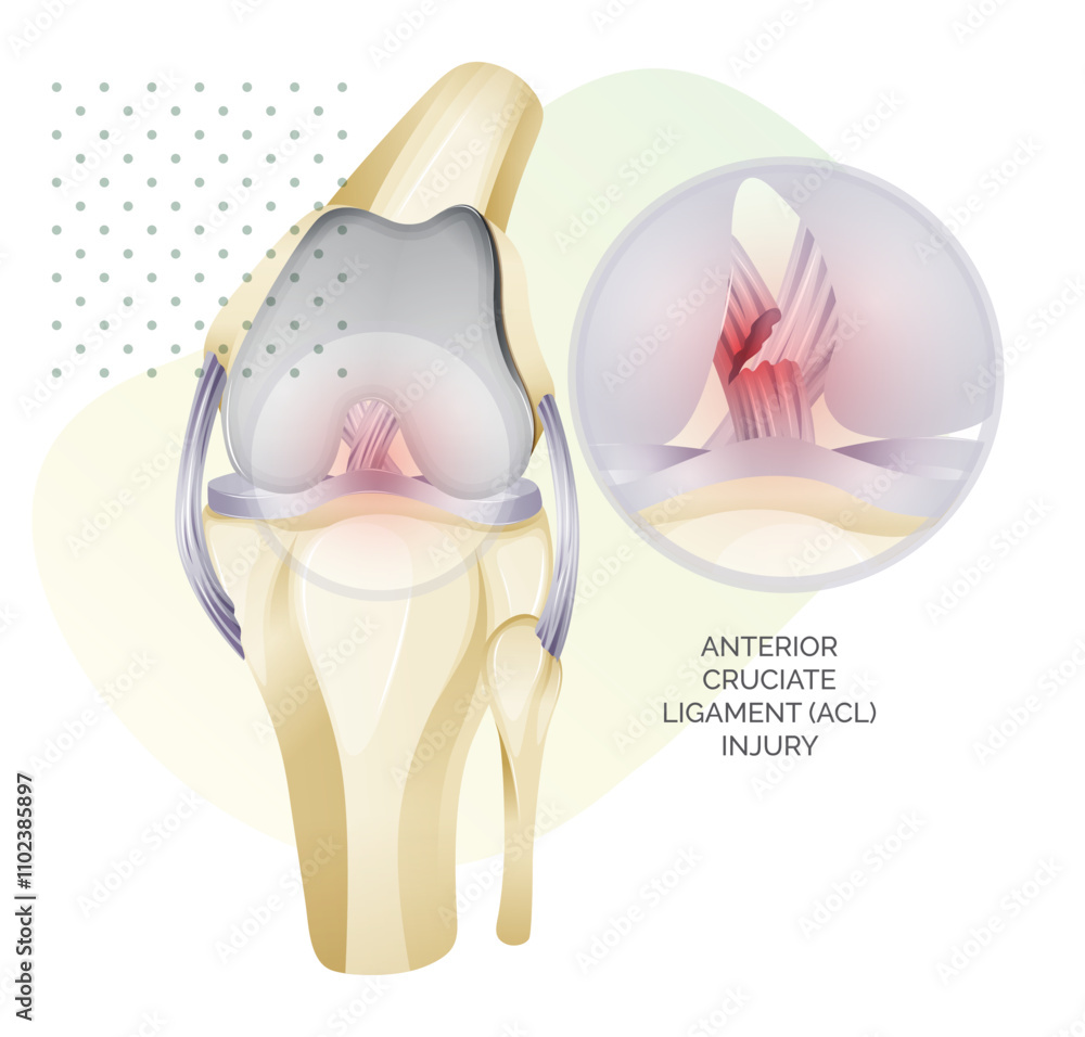 Obraz premium Knee Cartilage Anatomy - ACL Injury - Illustration