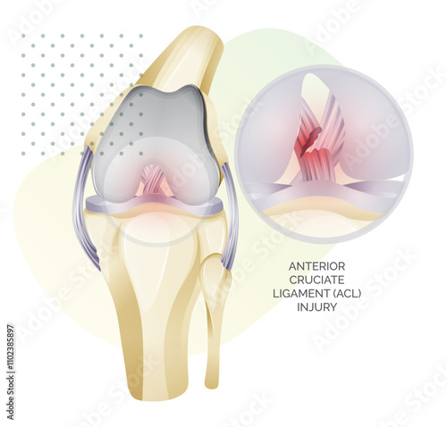 Knee Cartilage Anatomy - ACL Injury - Illustration