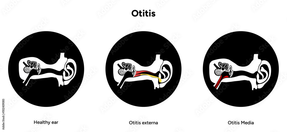 Otitis media and externa human ear anatomy disease medical infographic Otitis media and externa human ear anatomy disease medical infographic